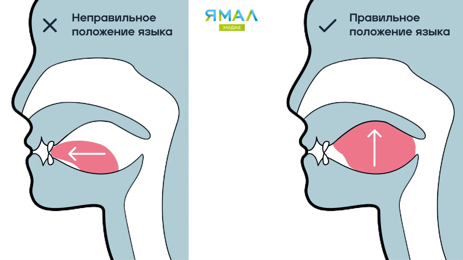 Мьюинг: что это и как правильно делать упражнения для исправления прикуса и  формы лица | Ямал-Медиа