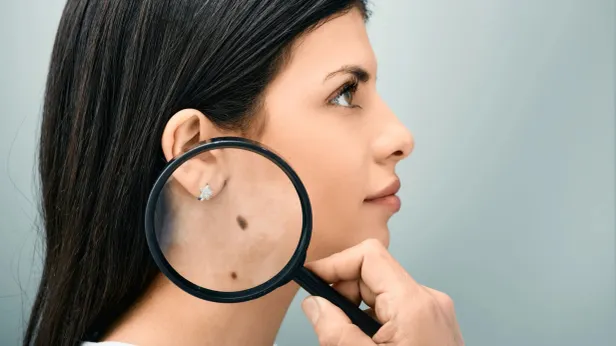 Родинки крупным планом: индивидуальность или скрытая угроза